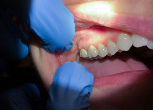 Best Emergency Dental Care for Abscessed Tooth in Falconer, NY